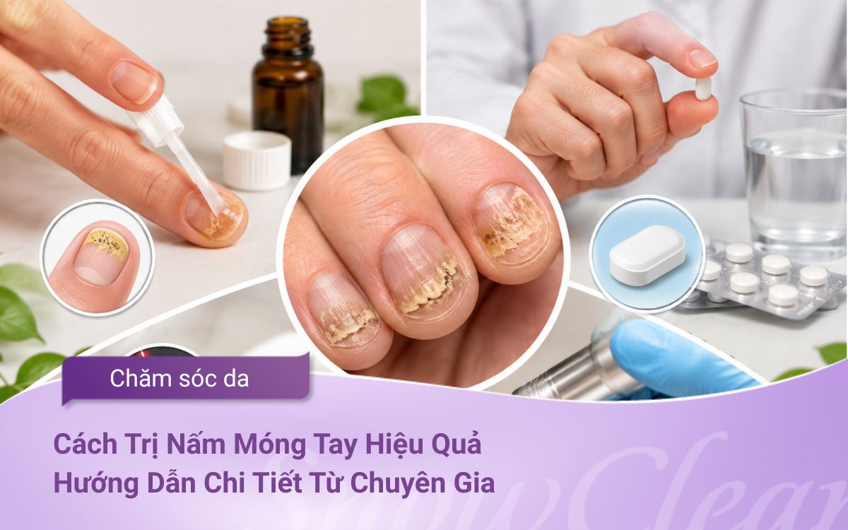 Cách Trị Nấm Móng Tay Hiệu Quả: Hướng Dẫn Chi Tiết Từ Chuyên Gia