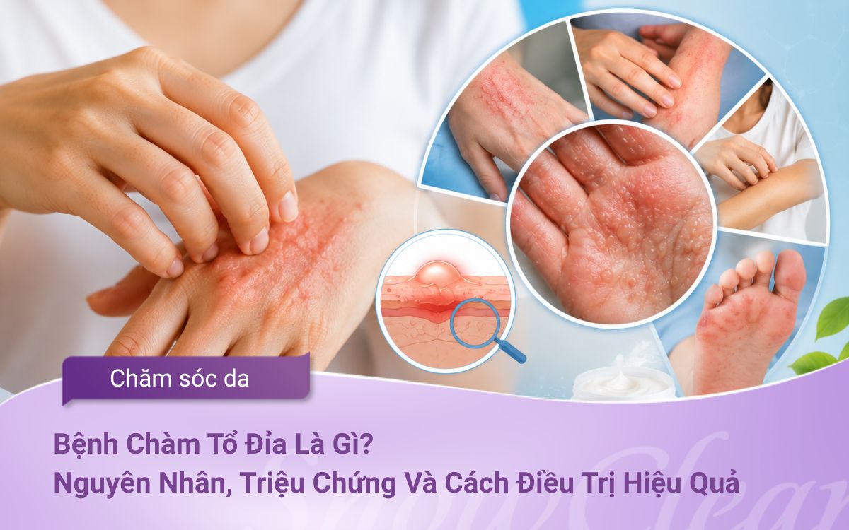 Bệnh Chàm Tổ Đỉa Là Gì? Nguyên Nhân, Triệu Chứng Và Cách Điều Trị Hiệu Quả