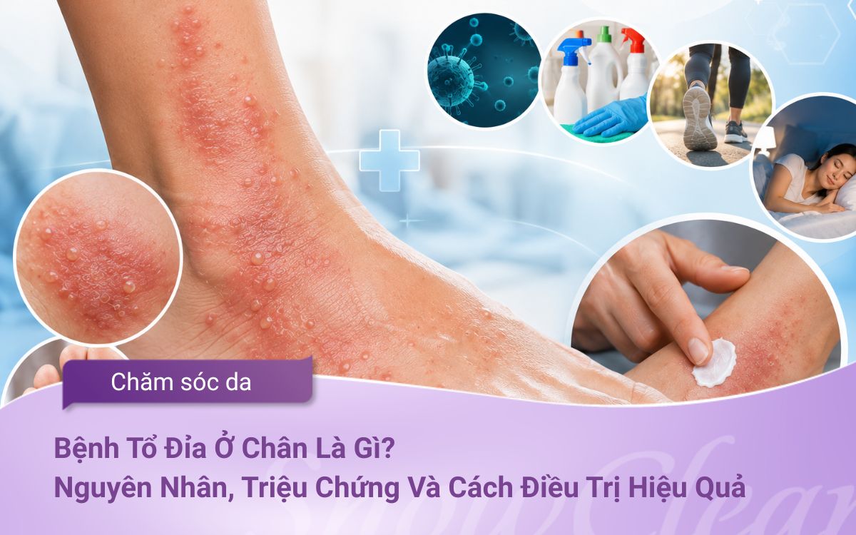 Bệnh Tổ Đỉa Ở Chân Là Gì? Nguyên Nhân, Triệu Chứng Và Cách Điều Trị Hiệu Quả