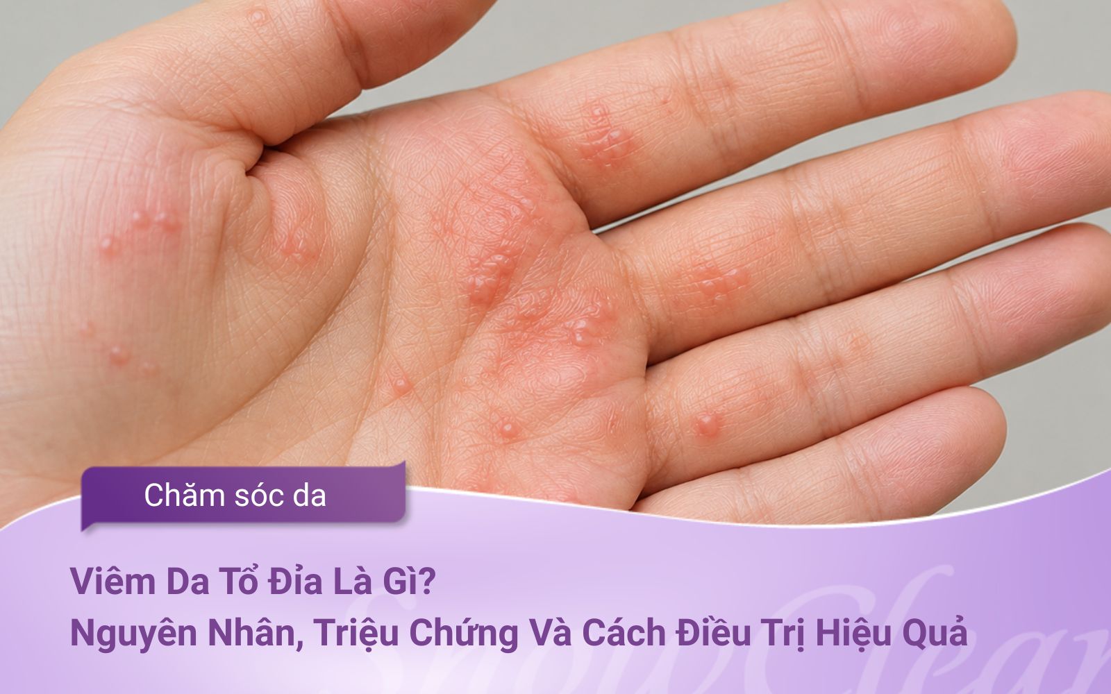 Viêm Da Tổ Đỉa Là Gì? Nguyên Nhân, Triệu Chứng Và Cách Điều Trị Hiệu Quả