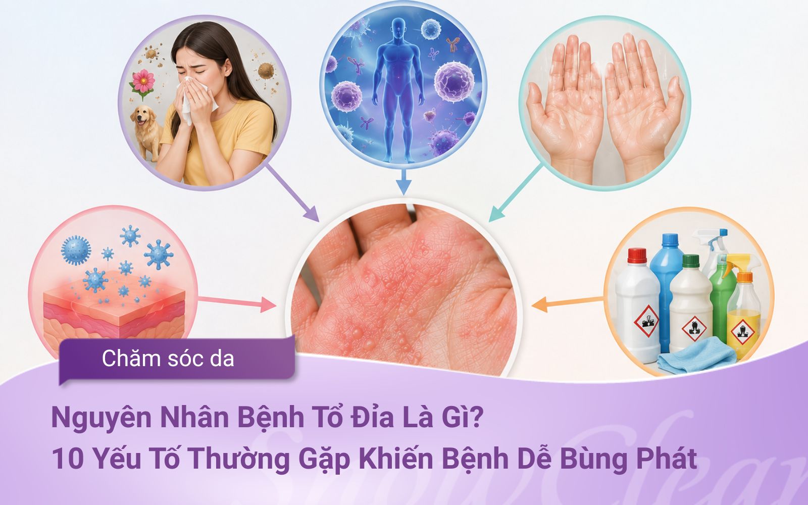 Nguyên Nhân Bệnh Tổ Đỉa Là Gì? 10 Yếu Tố Thường Gặp Khiến Bệnh Dễ Bùng Phát