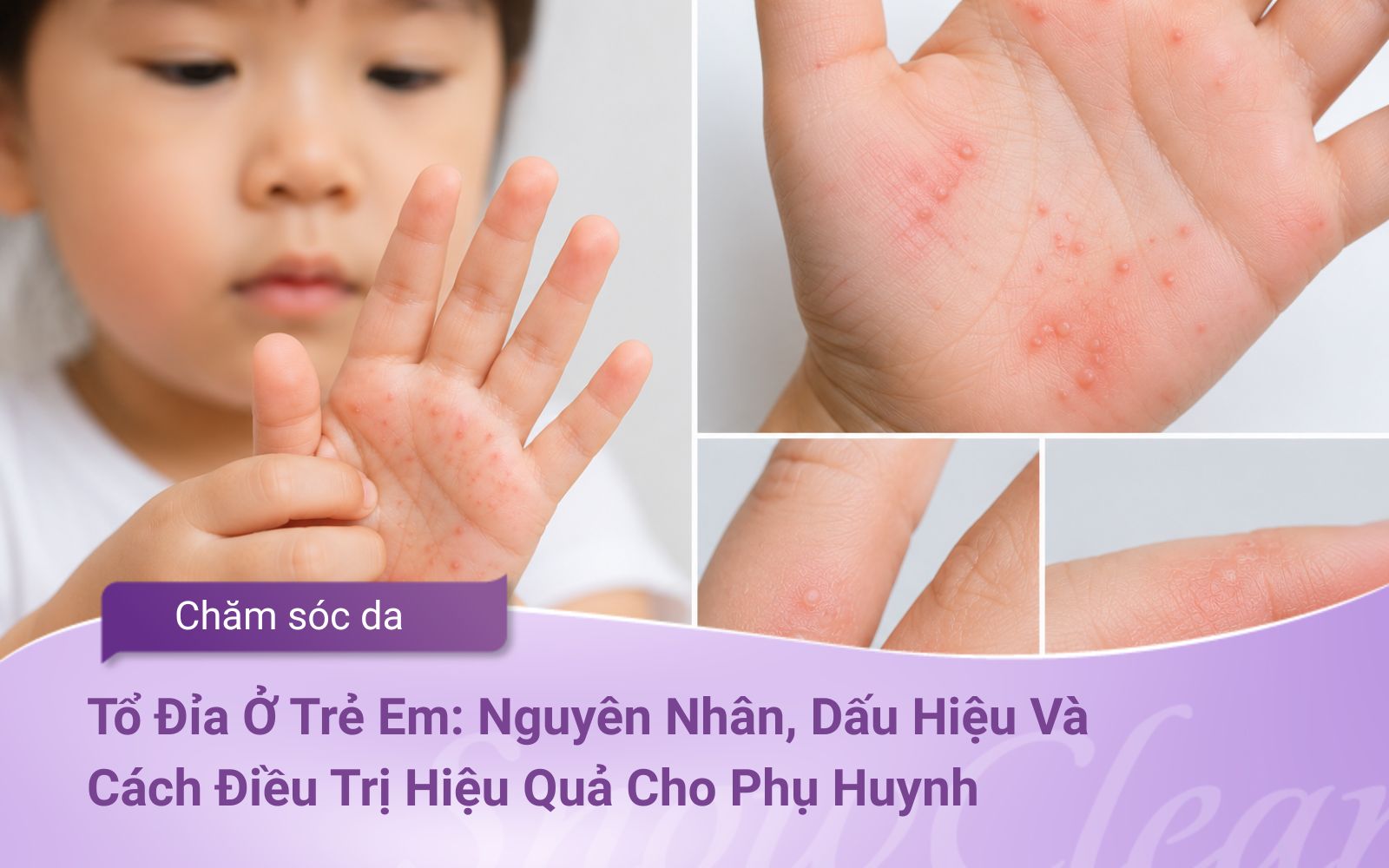 Tổ Đỉa Ở Trẻ Em: Nguyên Nhân, Dấu Hiệu Và Cách Điều Trị Hiệu Quả Cho Phụ Huynh