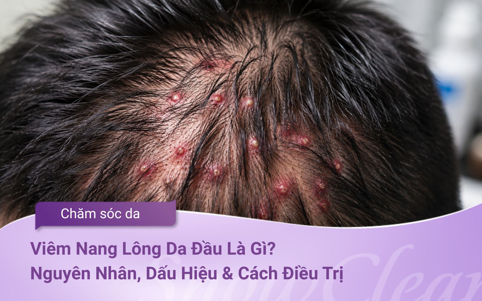 Viêm Nang Lông Da Đầu Là Gì? Nguyên Nhân, Dấu Hiệu & Cách Điều Trị