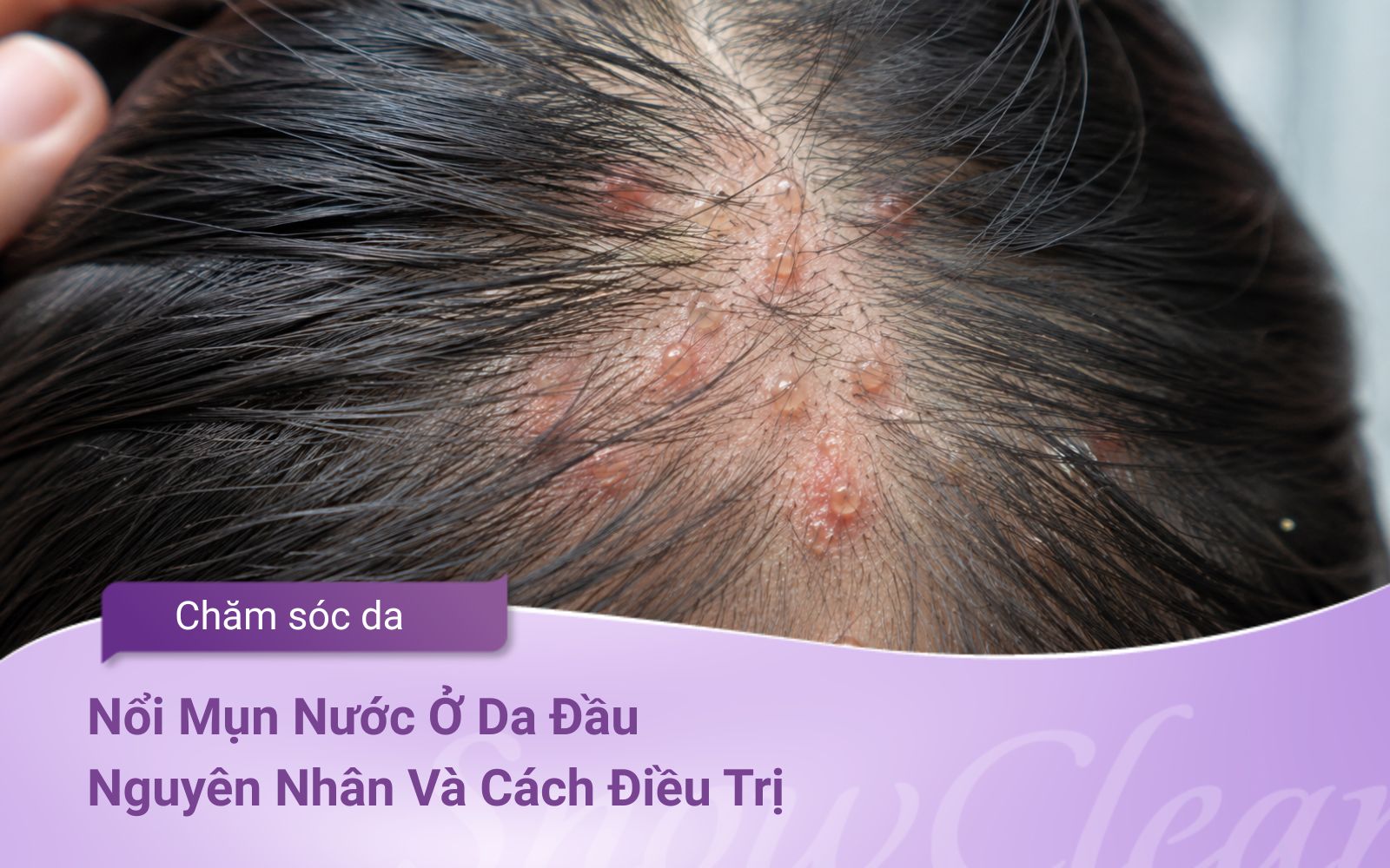 Nổi Mụn Nước Ở Da Đầu: Nguyên Nhân Và Cách Điều Trị