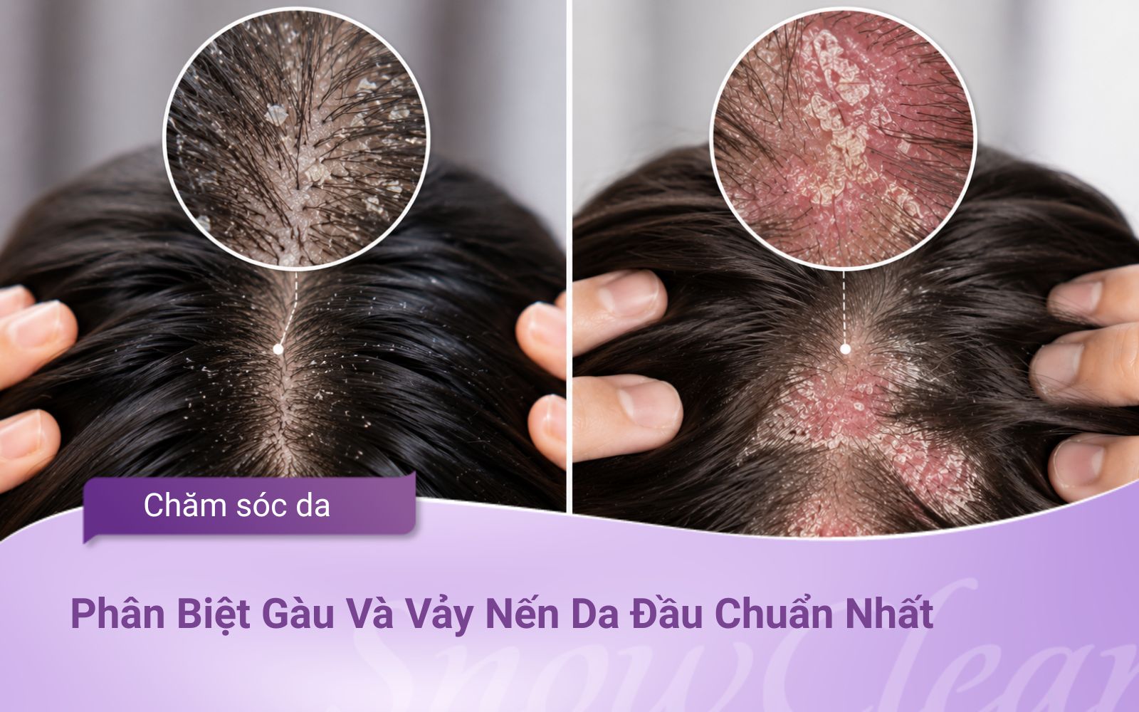 Phân Biệt Gàu Và Vảy Nến Da Đầu Chuẩn Nhất